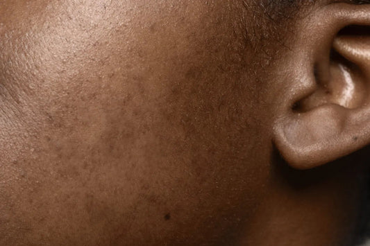 Which Lotion Is Best for Hyperpigmentation in Nigeria? - Nectar Beauty Hub