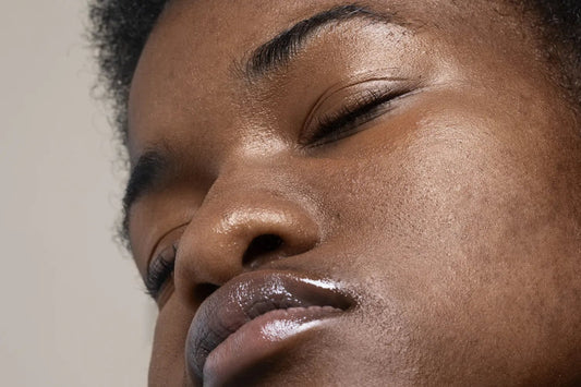 How To Get Rid Of Acne Scars in Nigeria - Nectar Beauty Hub