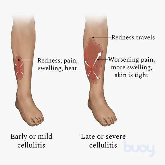 TRUTHS AND LIES ABOUT CELLULITIS - Nectar Beauty Hub